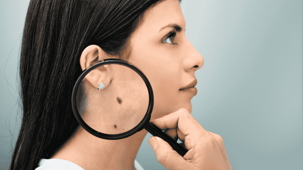 Câncer de Pele | Dra. Camila Laranjo | Dermatologista