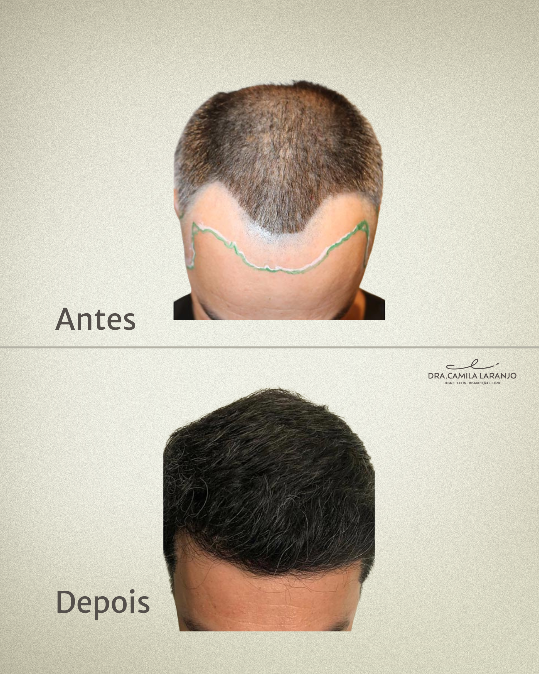 Antes e Depois - Caso 1
